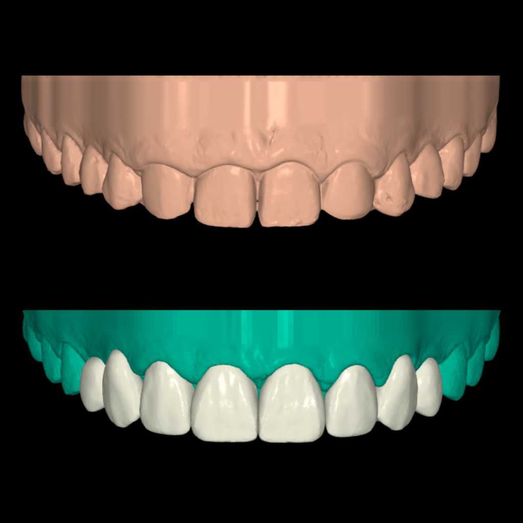 Carillas diseñadas digitalmente y sobre dientes naturales mínimamente tallados