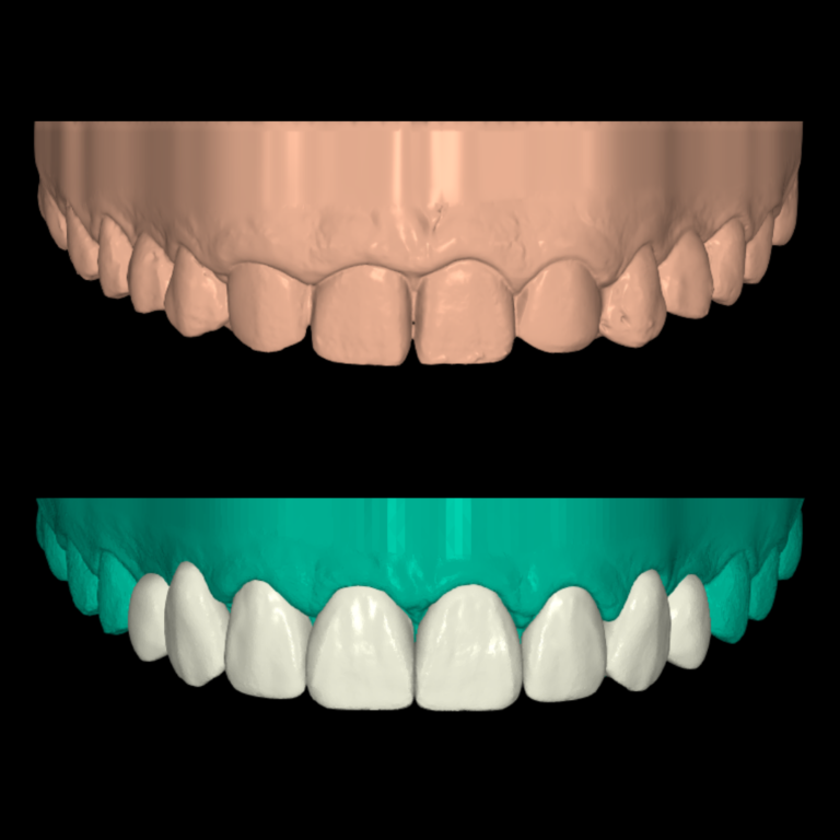 Restauraciones definitivas diseñadas digitalmente y sobre dientes naturales mínimamente tallados o implantes