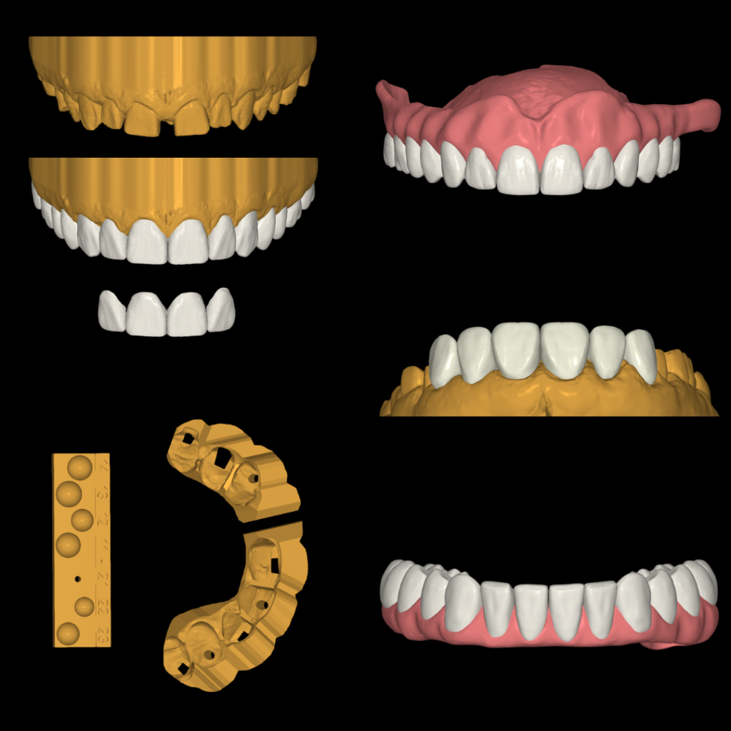 Diseño digital 3D de restauraciones dentales: encerado diagnóstico, mockup motivacional, guías de restauraciones directas, diseño de prótesis completas, diseño de carillas/coronas y diseño de provisionales de carga inmediata