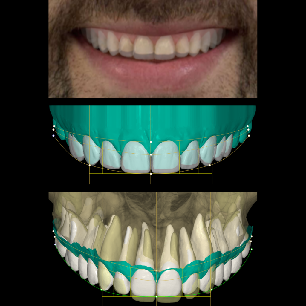 Planificación digital dental completa: Diseño de sonrisa 2D sobre foto real, Encerados Diagnósticos 3D y Simulación de ortodoncia con raíces del CBCT