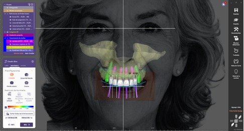 Curso de Planificación digital de un paciente con diseño facialmente guiado y planificación implantológica