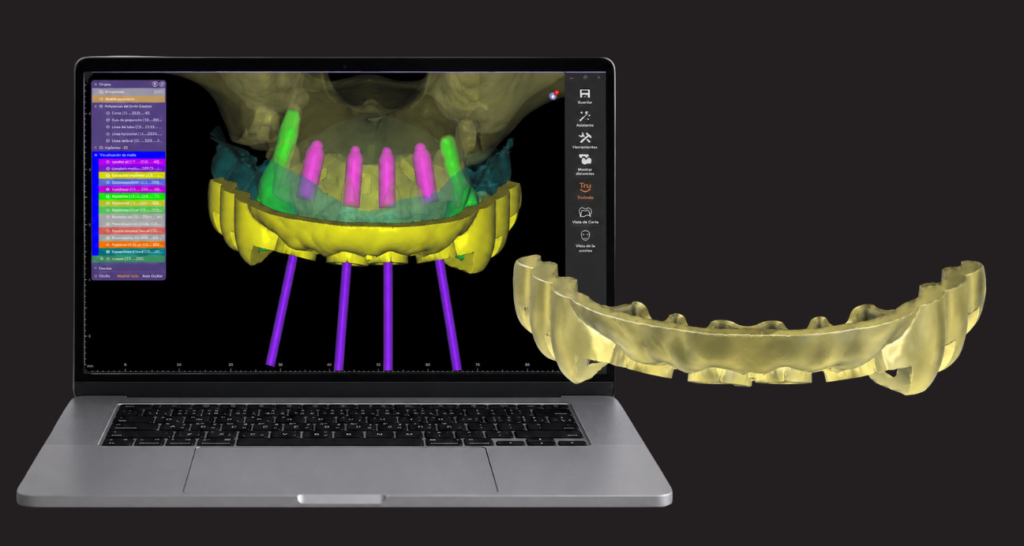 Flujo digital de diseño de guía quirúrgica e impresión 3D en implantología