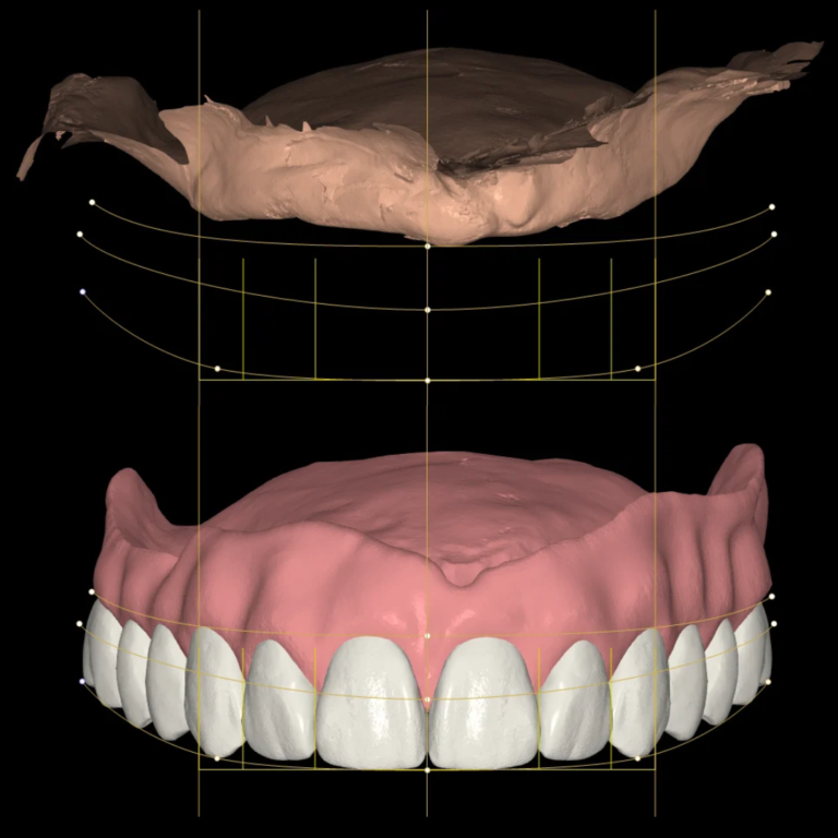 Diseño de Dentadura Completa Removible